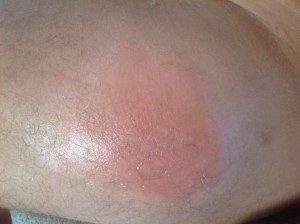 Brown Recluse Spider Bite