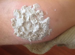 Bentonite Clay Poultice